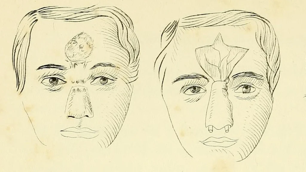 Alte indische Chirurgie: Rekonstruktion von Nasen nach Bestrafung