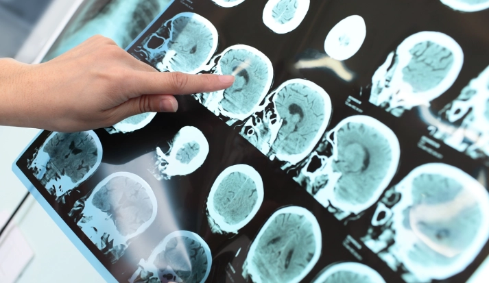 Schwimmen Könnte Ihr Gehirn Vor Alzheimer Schützen, Laut Ärzten