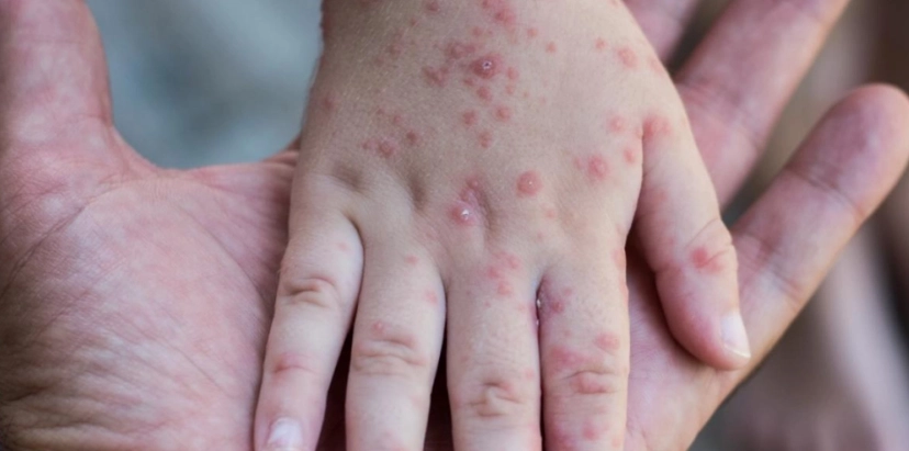 Mpox ist nicht das neue COVID, sagt WHO-Vertreter