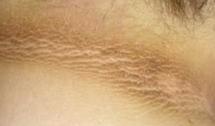 Dunkle Flecken am Hals? Oft ein Symptom dieser Krankheit