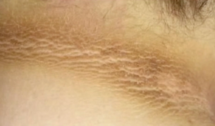 Dunkle Flecken am Hals? Oft ein Symptom dieser Krankheit